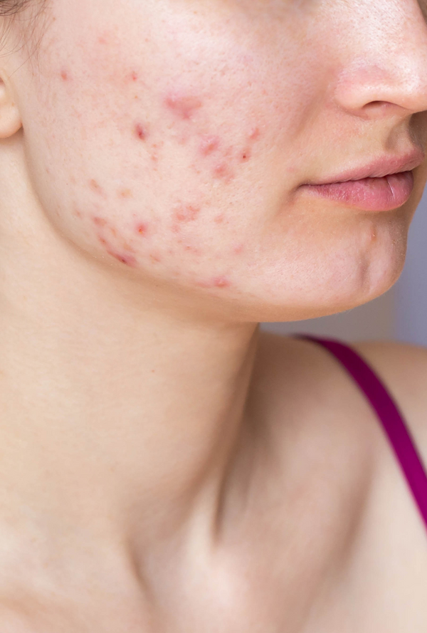 The Acne + Rosacea Program